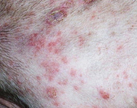 5 เรื่องที่คุณควรรู้ เมื่อ “น้องหมาเป็นตุ่มหนอง” (Impetigo) – โรคผิวหนังที่ไม่ควรมองข้าม (อัปเดท 2025)